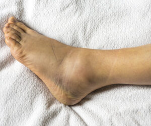 Edema on an inflamed ankle