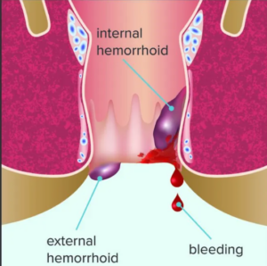 Graphic detailing internal and external hemorrhoids. Yuck.