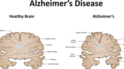 A graphic that depicts a health brain compared to a brain with Alzheimer's disease.