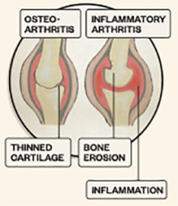 Graphic of osteoarthritis