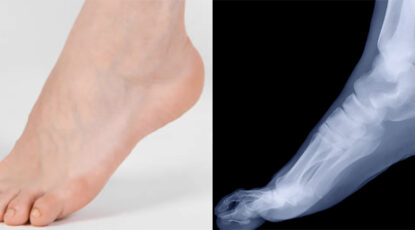 Graphic of two feet side by side -- image and xray