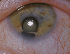 Closeup of a human eye with Cat Eye Syndrome, a rare chromosome disorder, usually diagnosed in children. It usually appears as a hole in the iris below the pupil, resulting in an elongated pupil resembling the appearance of a cat’s eye