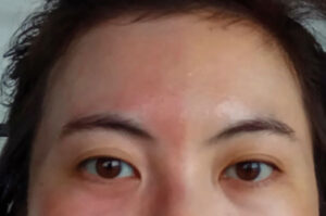 Part of a face, showing the eyes and forehead of a person with Harlequin Syndrome in which one half of the face sweats and is a different color than the other.