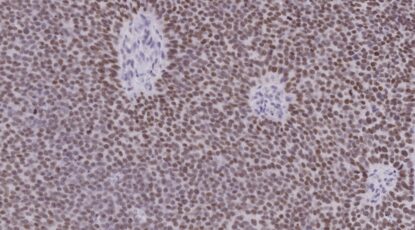 Microscopic image looks like purplish and brownish ovals covering the screen. It shows PROX1 expression in a double-negative prostate tumor.