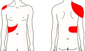 A side by side illustration of an outline of a body, front and back, with red indicators to describe pain and how it radiates,