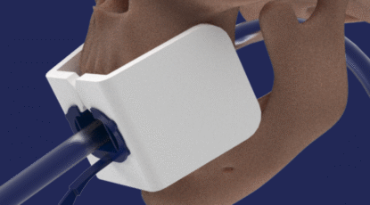white mouthguard device