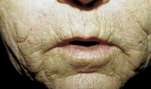 Closeup image of wrinkles around a mouth.