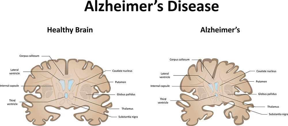 A graphic that depicts a health brain compared to a brain with Alzheimer's disease.