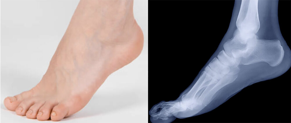 Graphic of two feet side by side -- image and xray